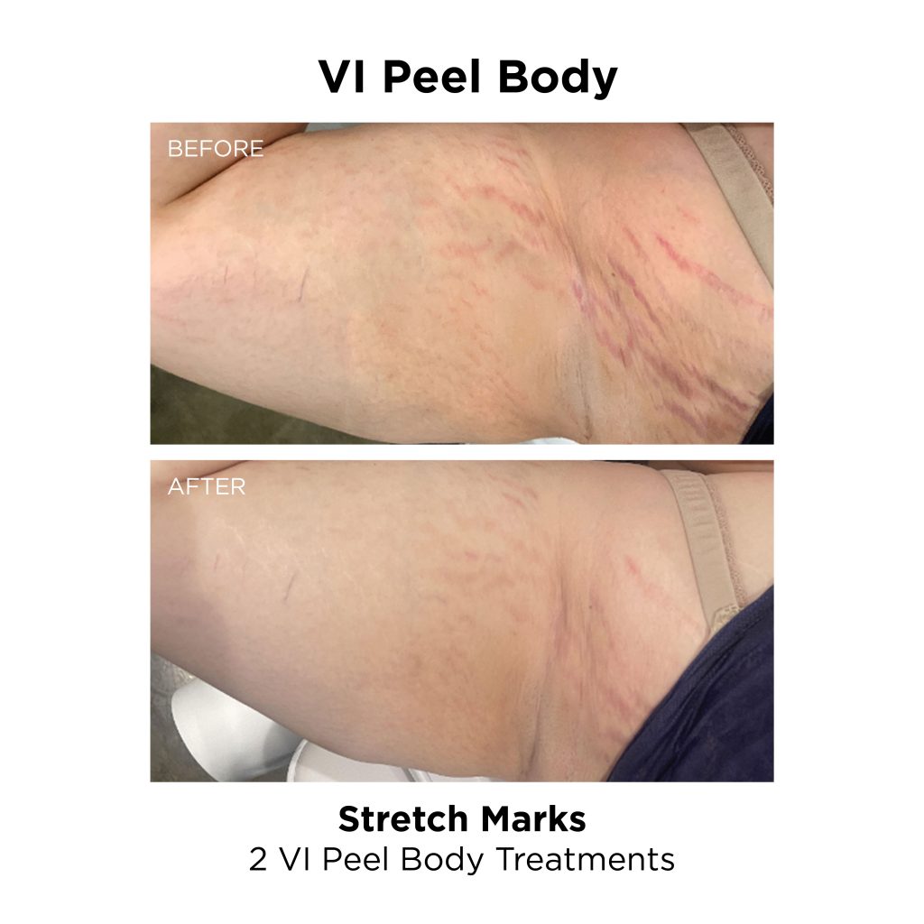 VI Peel Body_Stretch Mark