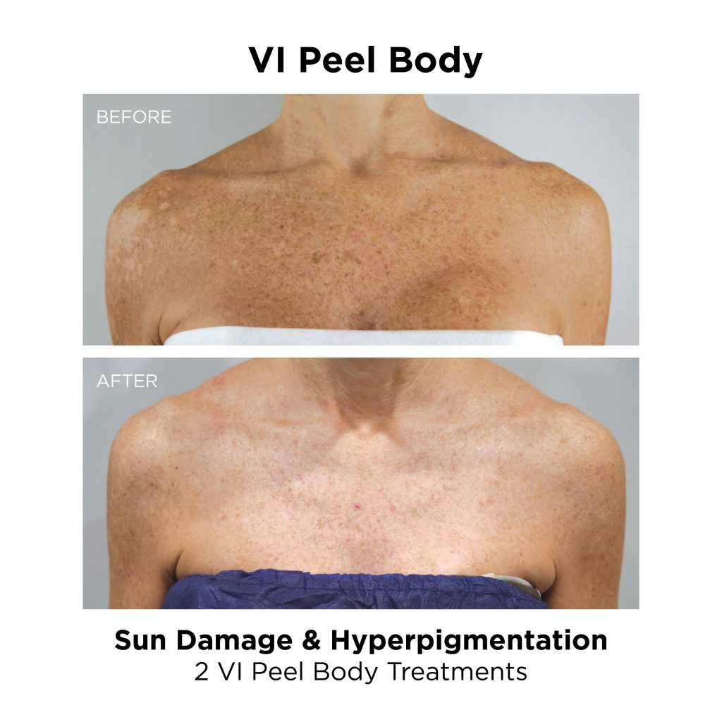 VI Peel Body_Sun Damage
